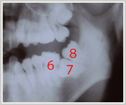 部分的な歯の移動-治療前