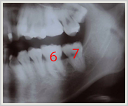 部分的な歯の移動-治療後