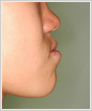 下顎前突・偏位-治療前-横顔