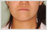 下顎前突・偏位-治療前-正面顔