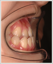 下顎前突・偏位-治療前-噛み合わせ側面