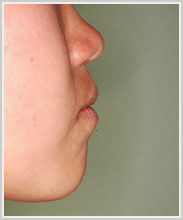 下顎前突・偏位-治療後-横顔
