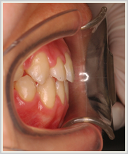 下顎前突・偏位-治療後-噛み合わせ側面