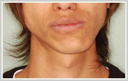 顎偏位-治療前-正面顔