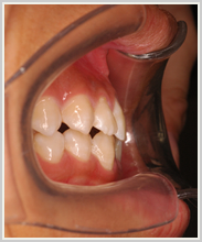 顎偏位-治療前-噛み合わせ側面