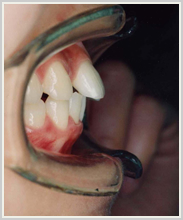 上下顎前突-治療前-噛み合わせ側面