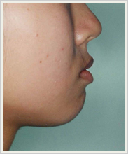 上下顎前突-治療前-横顔