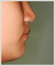 上顎前突-治療前-横顔