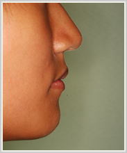 上顎前突-治療後-横顔
