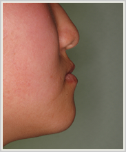 下顎前突-治療前-横顔
