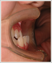 下顎前突-治療前-噛み合わせ側面