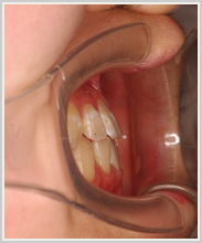 下顎前突-治療後-噛み合わせ側面